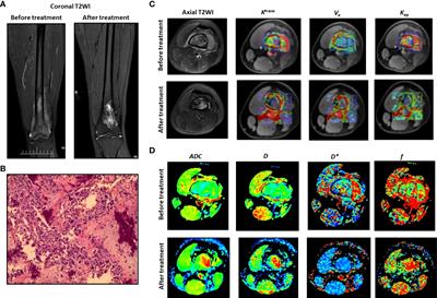 Predictive value of DCE-MRI and IVIM-DWI in osteosarcoma patients with neoadjuvant chemotherapy